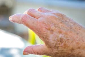Elder Care in Philadelphia PA: 5 Skin Cancer Myths